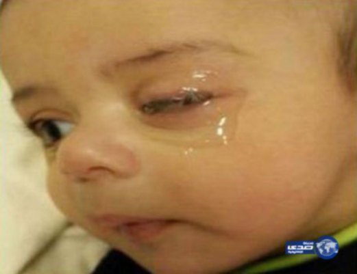 Kasihan. Keadaan mata bayi yang digam oleh abangnya. Foto dari Harian Metro