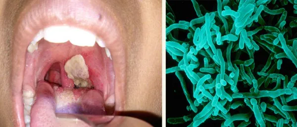 Jangkitan Difteria pada tekak dan gambar kanan, bakteria Corynebacterium Difteriae punya penyakit itu. Foto -Healthline.com/Alain Grillet