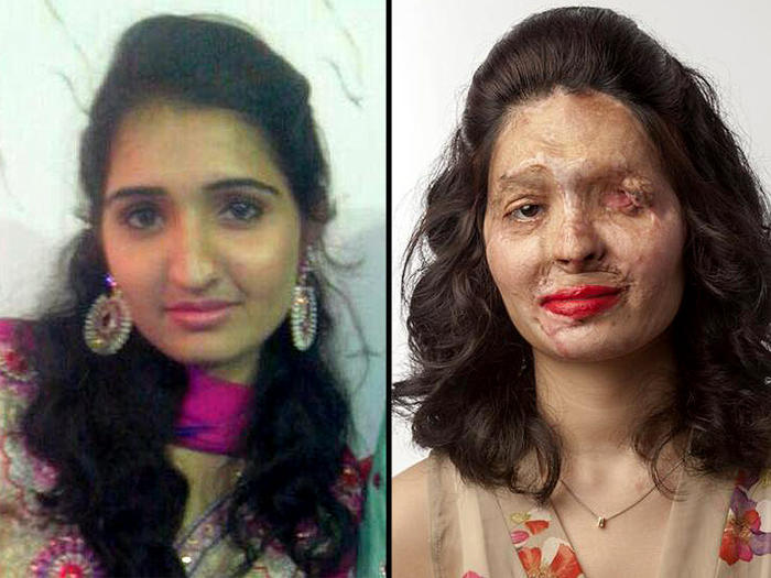 Wajah Reshma Qureshi sebelum dan selepas disimbah asid. Foto - google.com