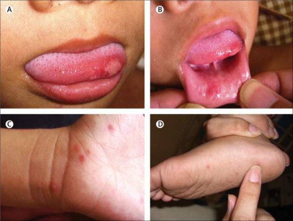 Penyakit tangan, kaki dan mulut (HFMD) kebanyakannya berjangkit kepada kanak-kanak berumur 10 tahun ke bawah. Foto - Google Image